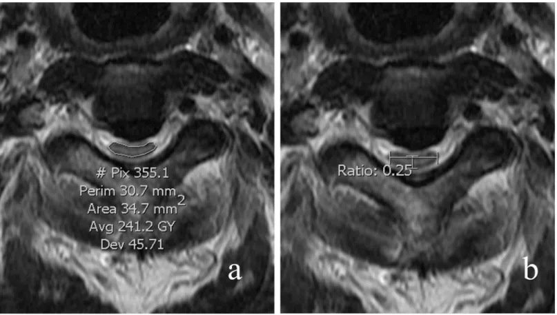 Fig 6. The cross-sectional area of the spinal cord was measured on MR axial imaging at the most compressed segment