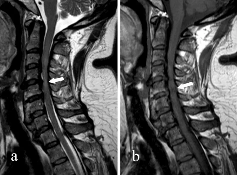 Fig 7. Intramedullary changes in signal intensity on both T1-weighted imaging (T1WI) and T2-weighted imaging (T2WI) of MRI were assessed