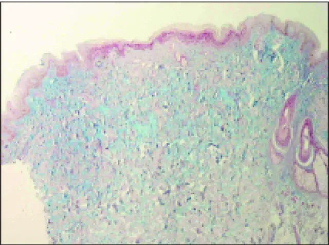 Figura 4. Corte histológico utilizando coloração por  Alcian Blue demonstrando depósito de mucina na derme.