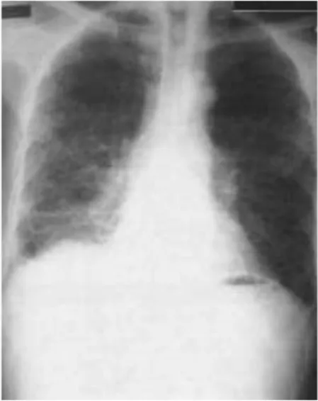 Figura 1. Condensação do lobo inferior direito, observado através da radiografia de tórax PA