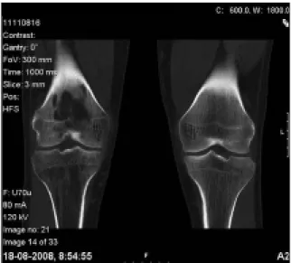Figura 4. Cintilografia óssea que mostra hiperfixação do radiofármaco na projecção do joelho direito mais evidente na fase tardia.