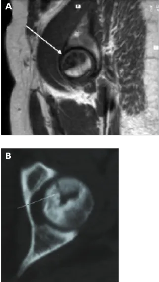 Figura 2. A) A RMN mostrou uma extensa área de necrose à esquerda (&gt;50% da área da cabeça), assim como a TAC  B).