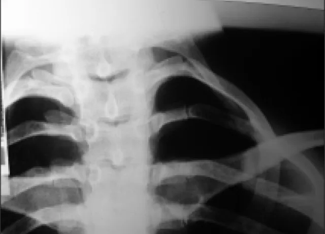 Figure 2. Radiography of the thorax showing bilateral cervical ribs.
