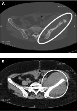 Figura 2. Na cintigrafia óssea há aumento intenso da  vascularização na região do ilíaco esquerdo; no estudo  tardio, observa-se aumento difuso da fixação do  rádio-fármaco em todo o ilíaco esquerdo.