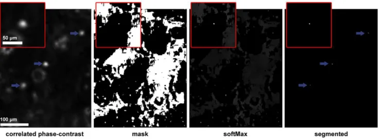 Figure 3. Cell detection in a correlated volume. Illustration of (a part of) a single Z-slice containing 3 cells in focus (pointed by arrows) submitted to the different segmentation steps (correlated phase-contrast, mask, softMax and the final segmented vo