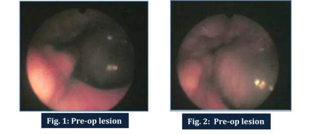 Fig. 1: Pre-op lesion Fig. 2:  Pre-op lesion