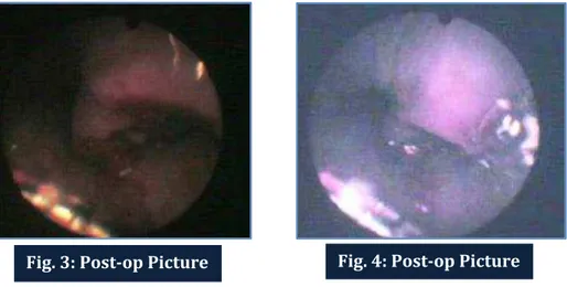 Fig. 3: Post-op Picture  Fig. 4: Post-op Picture 