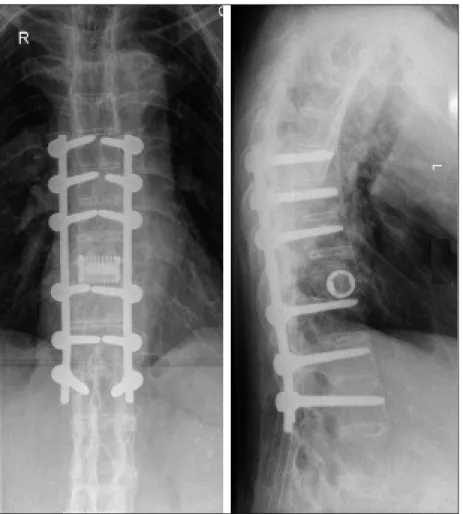 Figure 5. Thoracolumbar spine radiograph after osteotomy and re-alignment of the spine with fixation rods from T7-L1 and cage insertion at the level of T10-T11.