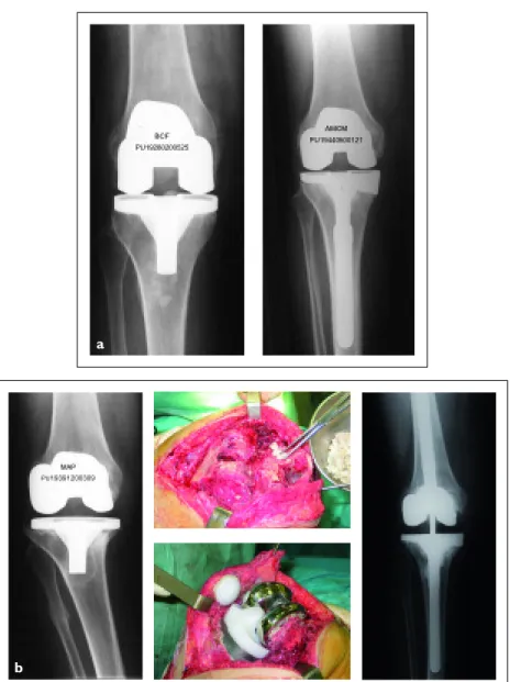 Figura 1. Cirurgia de substituição articular: a) próteses totais primárias do joelho, cimentadas, com sacrifício do  ligamento cruzado anterior