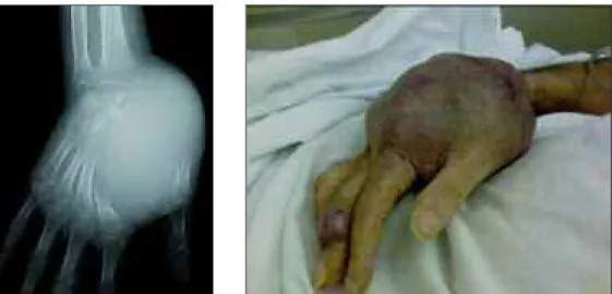 Figura 6. a) Agravamento radiológico marcado na última vinda do doente ao SU; b) Aspecto da mão  direita do doente um dia antes da sua morte.