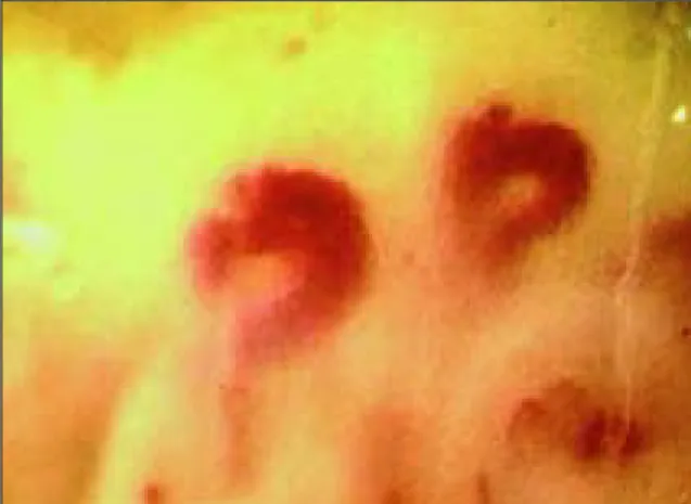 Figure 6.The hallmark of the scleroderma pattern is the presence of megacapillaries (magnification 200x)Figure 3.The «early» scleroderma NVC pattern 