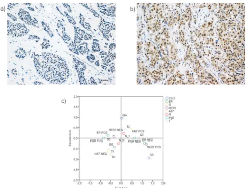Fig 7. Immunohistochemical analyses. Representative immunohistochemical figures of ductal infiltrating breast cancer with low VDR expression (score 3) (a) and with high VDR expression (score 8) (b)