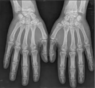 Figura 1 (Caso clínico 1). Radiografia das mãos AP com distribuição simétrica. A avaliação analíticanão revelou alterações
