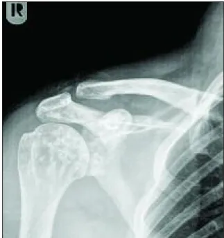 Figura 4 (Caso clínico 1).Radiografia do ombro esquerdo  AP