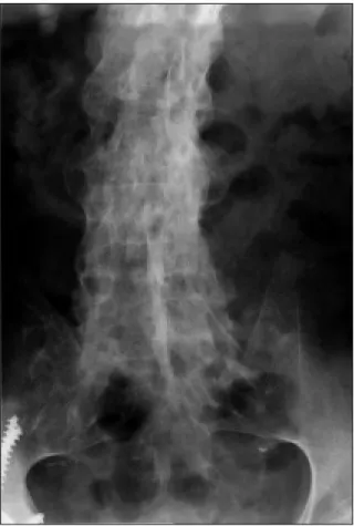Figura 3. Radiografia anteroposterior da coluna lombar mostrando anquilose vertebral e calcificação do ligamento longitudinal posterior.