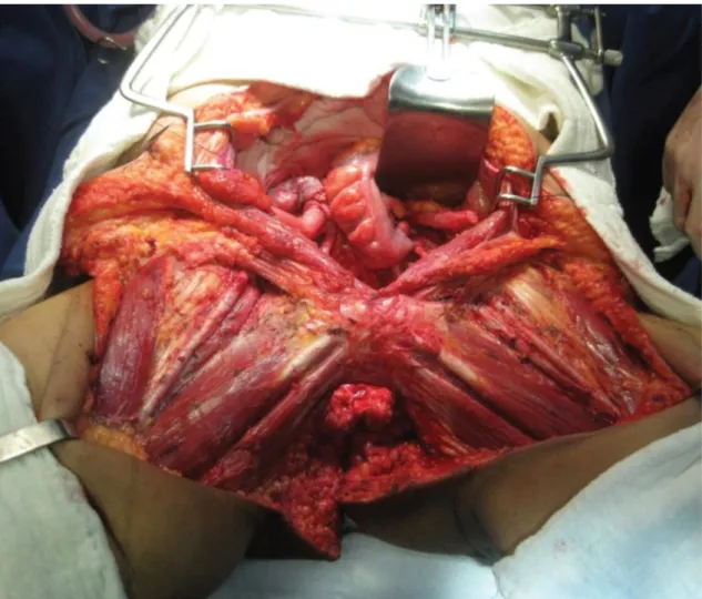 Figura 3. Peça cirúrgica onde se observa a ressecção em monobloco da bexiga, útero e  paramétrios, reto, vulva e linfonodos inguinais bilaterais
