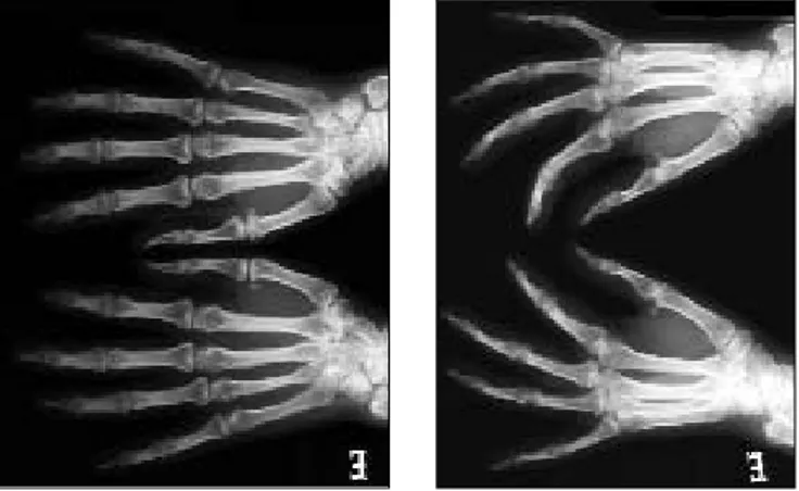 Figura 1. Radiografia das mãos: osteopénia difusa; acro-osteólise das falanges do segundo dedo da mão esquerda e do terceiro dedo da mão direita.