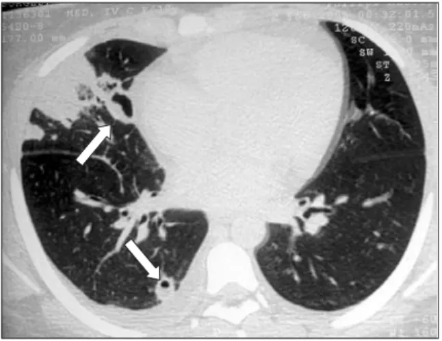Figura 4. Tomografia Axial Computorizada pulmonar (cortes de alta resolução) evidenciando pormenor de  abces-so no lobo médio com conteúdo gaabces-soabces-so no interior.
