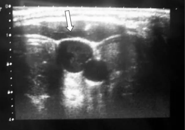 Figura 7.Ecografia cervical mostrando trombo aderente na veia jugular interna direita.