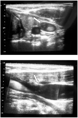 Figura 8 e 8a. Ecografia cervical/doppler venoso mostran- mostran-do trombo aderente na veia jugular interna esquerda.