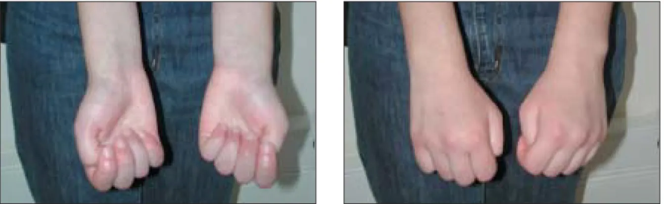 Figura 4 e 5. Postura actual das mãos, mantendo posição de flexão dos dedos.