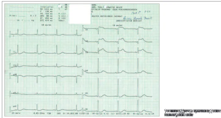 Abbildung 1: EKG mit typischen Angina pectoris-Beschwerden
