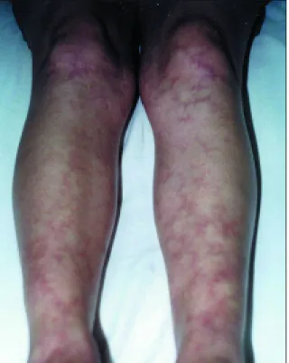 Figura 2. Aspecto de livedo reticularis.
