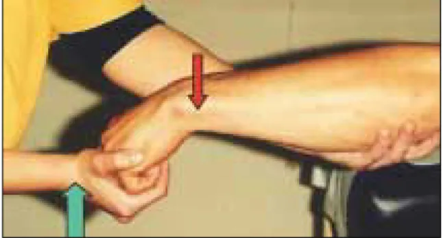 Figura 15. Resistência isométrica do curto extensor  do polegar para a doença de De Quervain.