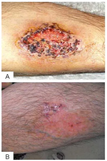 Abbildung 2:  Pyoderma gangraenosum vor  (A)  und 6 Wochen nach Anti-TNF-α-