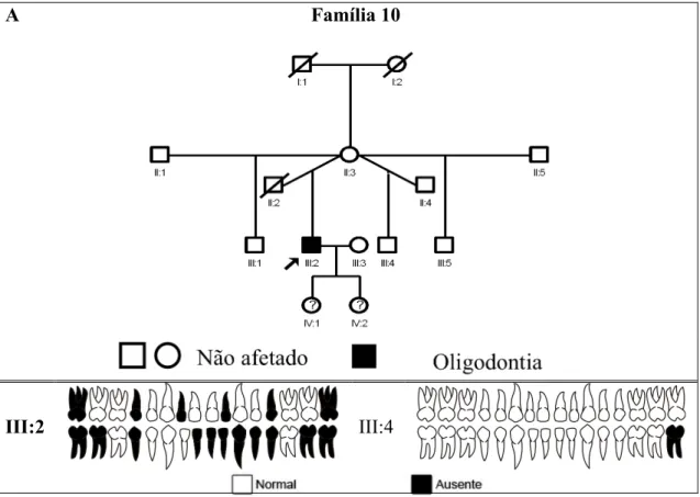 Figura 4: Família 10 com caso esporádico de oligodontia A) Heredograma. Os sinais  de “?” indicam crianças em que o diagnóstico da agenesia dentária é impreciso, pois  tinham três e um ano de idade, respectivamente