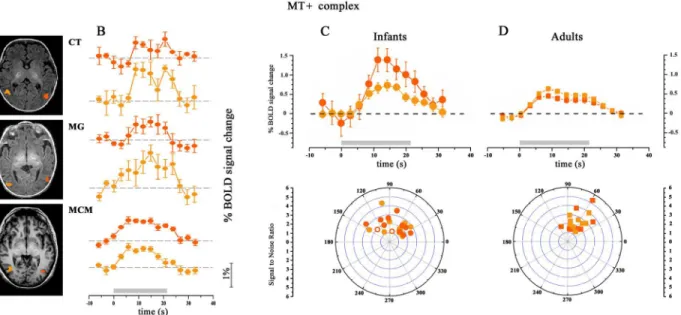 Fig 1. Localization and BOLD responses of complex MT+. A: Example of localization of complex MT+ in two infants (CT and MG) and one adult (MCM;