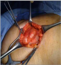 Figure 3. Pre-operative image showing the herniated ileum.