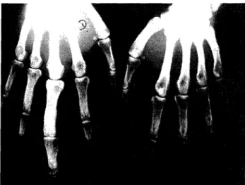 Fig. 1 - Radiograma simples das mãos em incidência dorso-pal- dorso-pal-mar. É visível um crescimento anormal de todas as estruturas  ósseas em relação com o terceiro dedo da mão direita  (metacar-po e falanges)