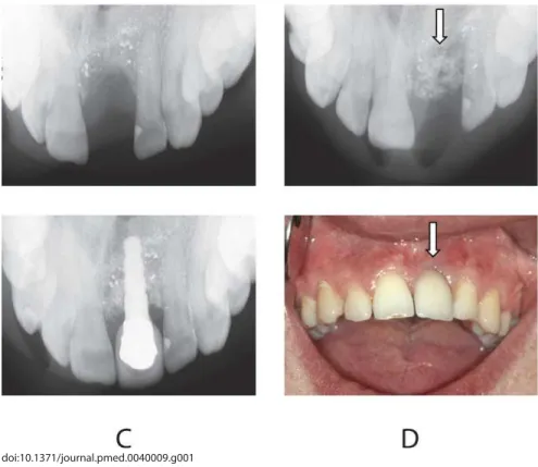 Figure 1. Alveolar Defect and Reconstruction with Tissue Engineering