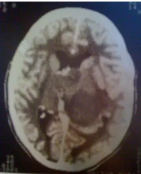 Figura 1. Tomografia computadorizada mostrando lesão expansiva   em região talâmica esquerda