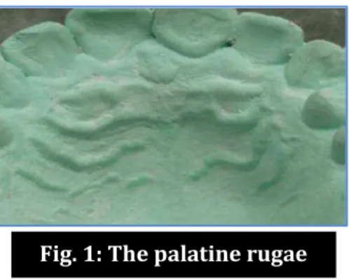 Fig. 1: The palatine rugae 