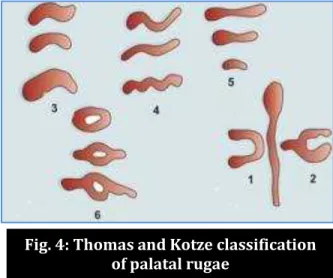 Fig. 4: Thomas and Kotze classification   of palatal rugae 