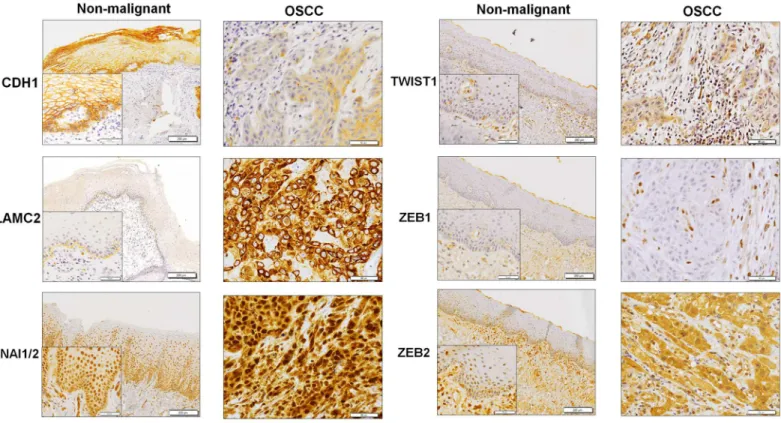 Table 2). Reduced CDH1 was observed in 64.9% of OSCC tissues compared to 20.7% of NOM tissues (p < 0.001; Table 2)