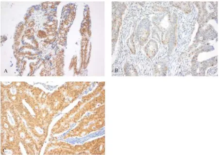 Fig 3. Staining pattern of MSH3 protein expression. Heterogeneous MSH3 protein expression (A), demonstrated by expression of both brown (positive) and blue (negative) nuclei upon MSH3 IHC staining.