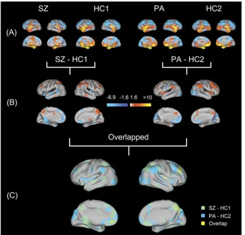 Figure 2. Surface renderings representing the results from the analysis of functional MRI data