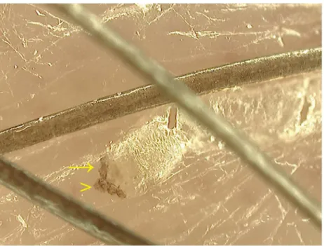 Fig 1. Sarcoptes scabiei observed by videodermatoscopy at X400 magnification. The mite, localized at the end of the burrow, has a roundish body and pigmented head (arrowhead) and anterior legs (arrow).