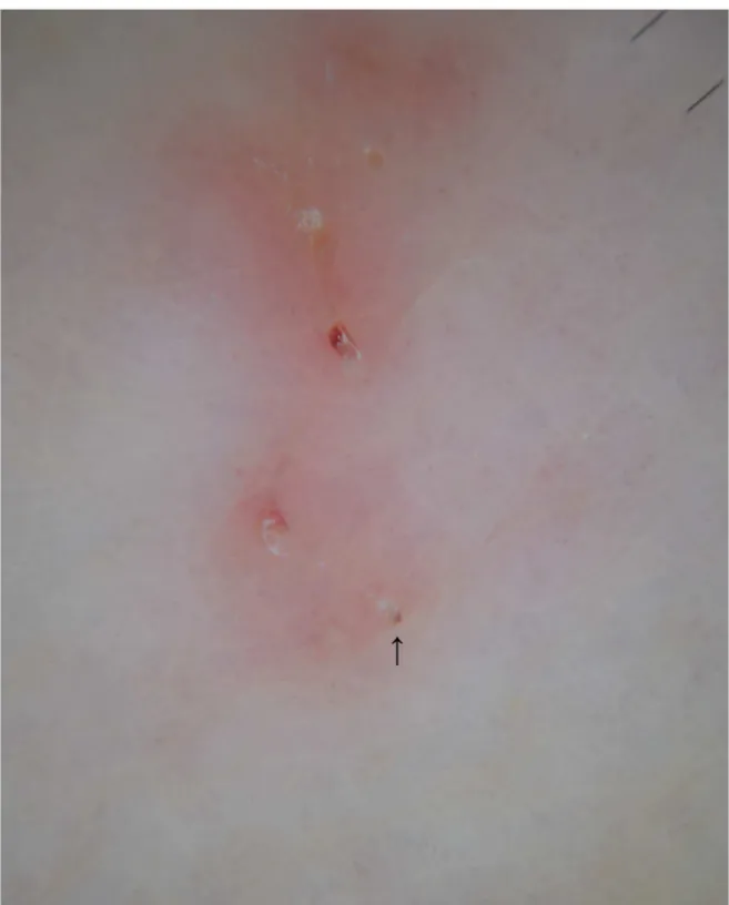 Fig 3. Burrow observed by dermatoscopy at X10 magnification. The jet-shaped triangular structure corresponds to the pigmented anterior part of Sarcoptes scabiei (arrow).