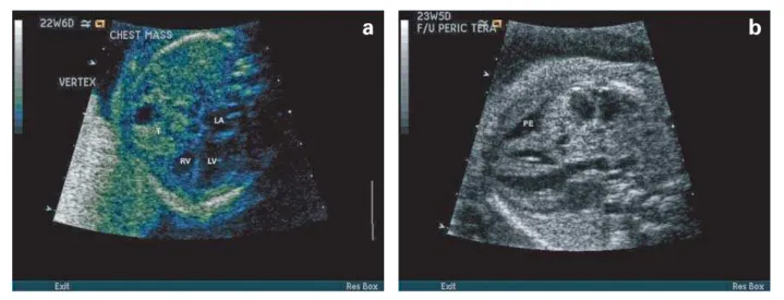 Figure 2. (a). Large, heterogeneous intrapericardial mass arising from the right atrial aortic pericardial fold, compressing the right atrium