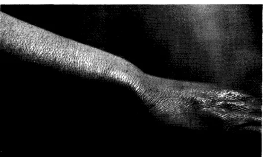 Fig. 2 — Deformidade de Madelung do punho (Punho em &#34;baioneta&#34;). 
