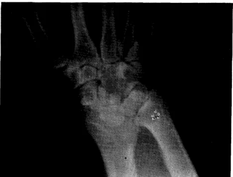 Fig. 4 _ Radiografia do punho (Conformação triangular do carpo com o semi-lunar no apex)