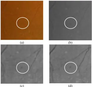 Fig. 5. Closeups of microaneurysm (a) Original RGB Image. (b) Green band. 