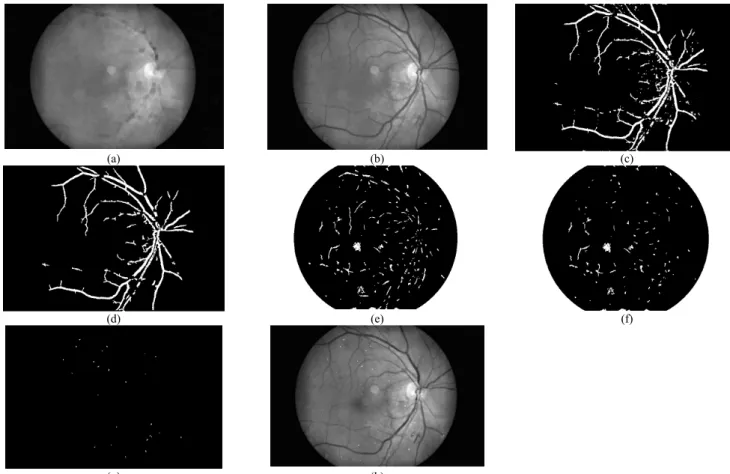 Fig. 7. Microaneurysm detection (a) Image after closing (b) F illed-in image (c) Difference image (d) Image after removal of object smaller than the size  of  microaneurysm from image (c) (e) Extended-minima transform image (f) Image after removal of vesse