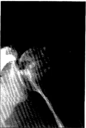 Fig. 2 — Osteonecrose de la tête humérale. 