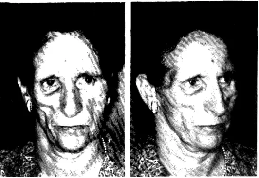 Fig. 1 (A e B) — Aspecto da face da doente evidenciando-se a acentuada atrofia hemifacial à direita,  acompanhada de endoftalmia homolateral