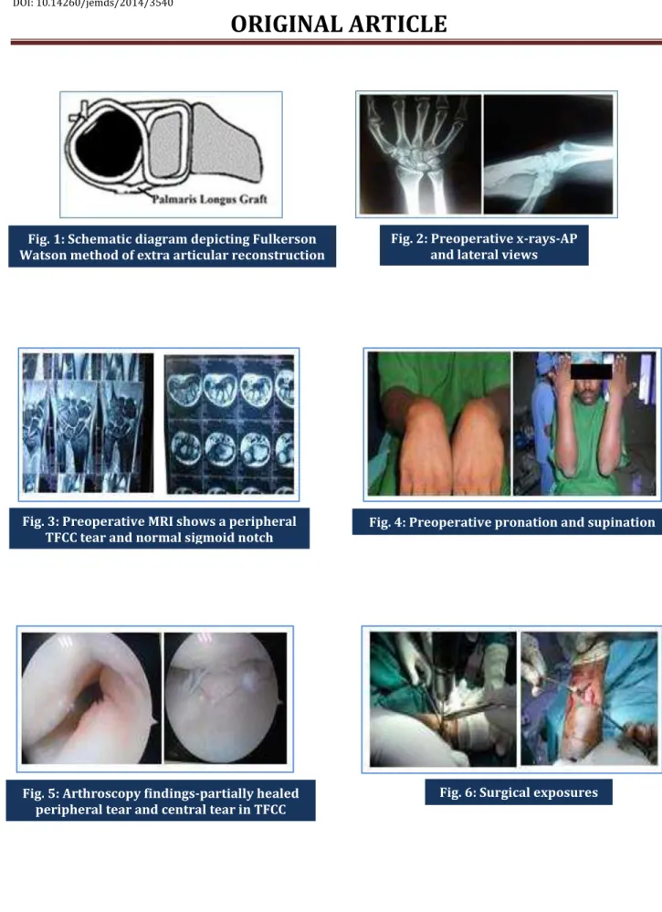 Fig. 1: Schematic diagram depicting Fulkerson  Watson method of extra articular reconstruction